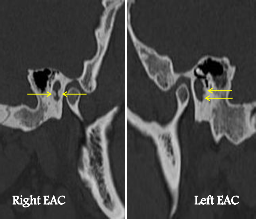 Exostosis Of The External Auditory Canal Surfer S Ear Image