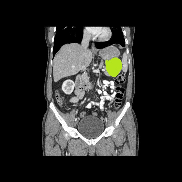 Pseudocyst Of Pancreas Image Radiopaedia Org