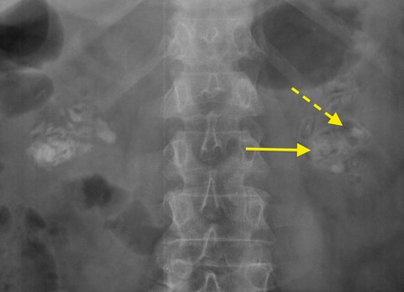 Emphysematous Pyelitis Radiology Reference Article Radiopaedia Org