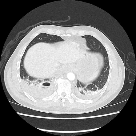 Pneumatocele Radiology Reference Article Radiopaedia Org