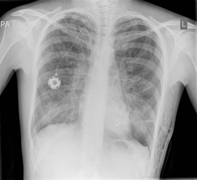 Cystic Fibrosis Pulmonary Manifestations Radiology Reference