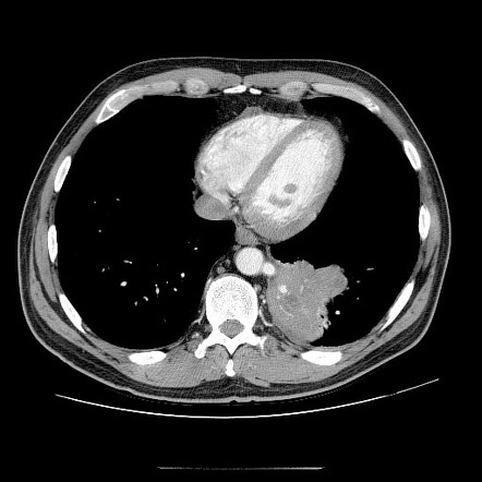 Pulmonary Sequestration Radiology Case Radiopaedia Org