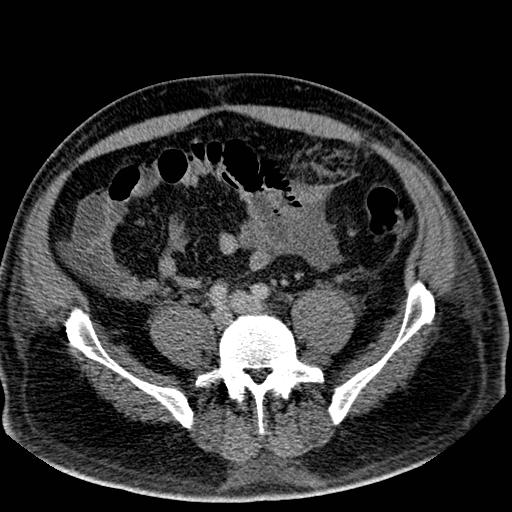 Omental Infarction Image Radiopaedia Org