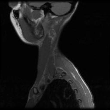 Brachial Plexus Cord Compression Injury Radiology Case Radiopaedia Org