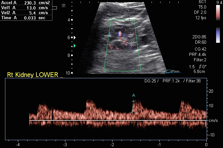 Renal Artery Stenosis Image Radiopaedia Org