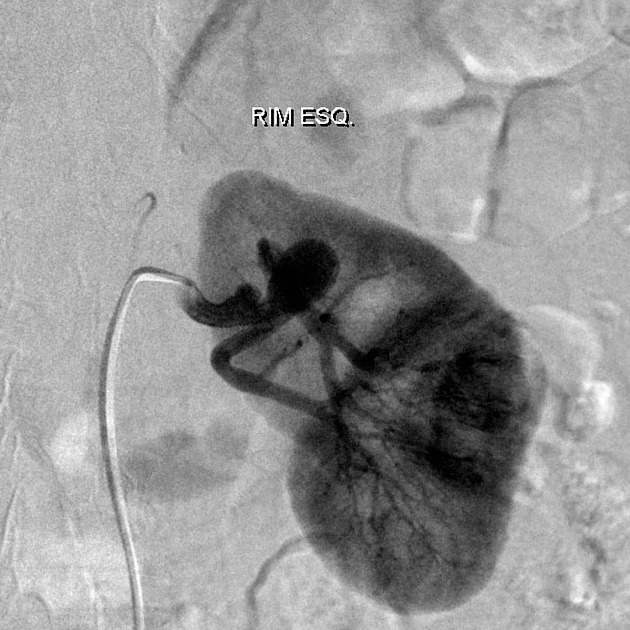 Renal Artery Aneurysm Radiology Reference Article Radiopaedia Org