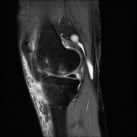 Morel Lavall E Lesion Of Knee With Osteochondral Fractures Image