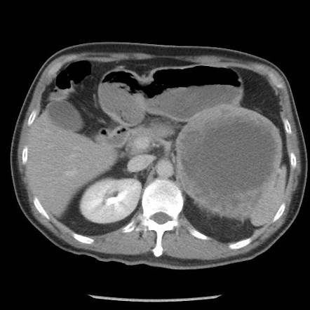 Gastrointestinal Stromal Tumor Radiology Case Radiopaedia Org