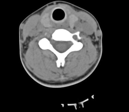 Hangman S Fracture Image Radiopaedia Org