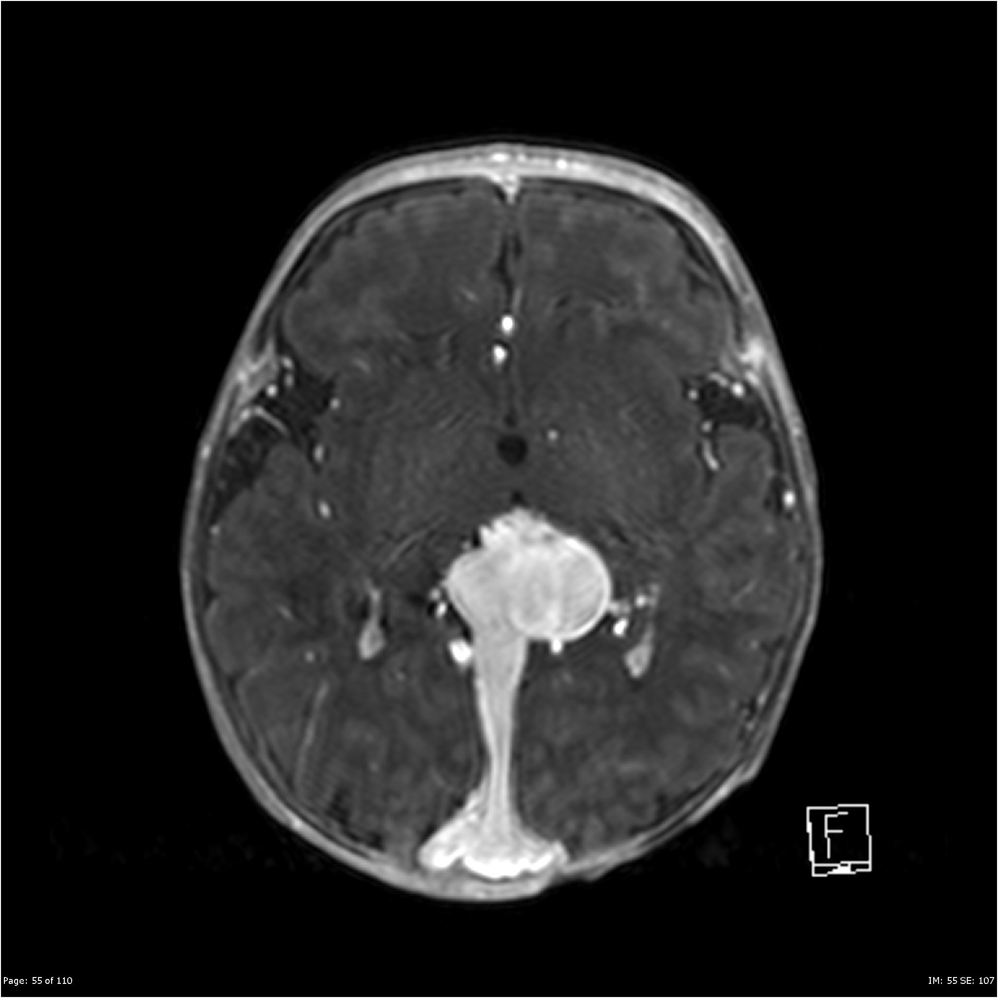 Vein Of Galen Malformation Image Radiopaedia Org