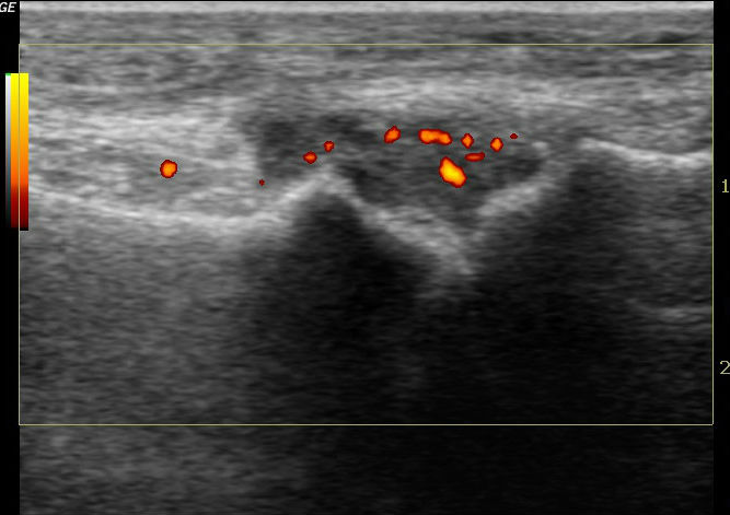 1st Metatarsophalangeal Joint Synovitis Image Radiopaedia Org