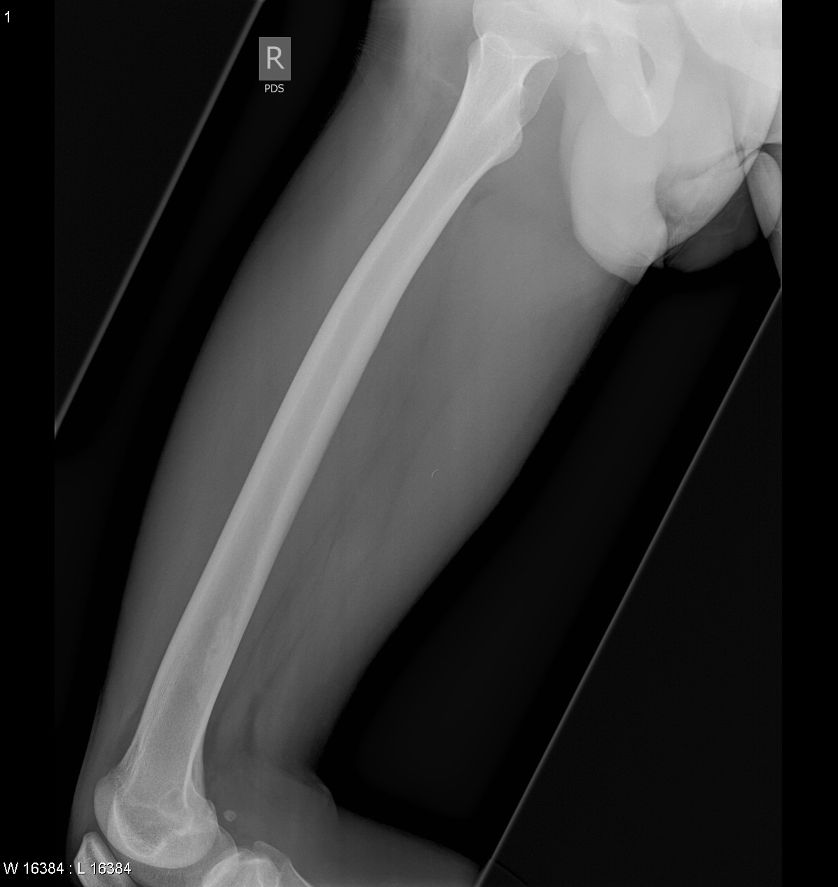 Xray Femur