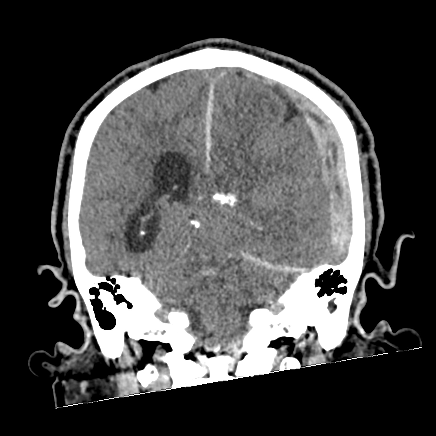 File Subdural Hematoma Uncal Herniation And Duret Brainstem Hemorrhage