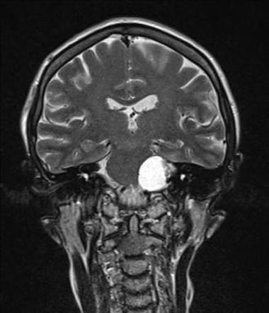 Cystic Acoustic Schwannoma Image Radiopaedia Org