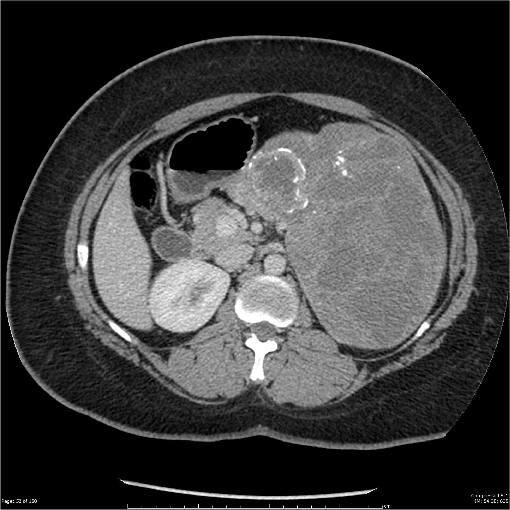 Solid Pseudopapillary Tumor Of The Pancreas Image Radiopaedia Org