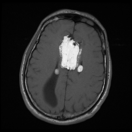 Pericallosal Lipoma Radiology Reference Article Radiopaedia Org