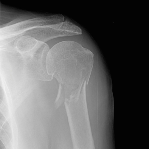 Shoulder radiograph (an approach) | Radiology blog post | Radiopaedia.org