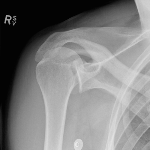 Shoulder radiograph (an approach) | Radiology blog post | Radiopaedia.org