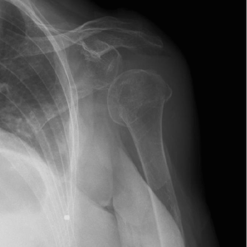 Shoulder radiograph (an approach) | Radiology blog post | Radiopaedia.org