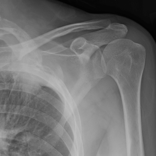 Shoulder radiograph (an approach) | Radiology blog post | Radiopaedia.org