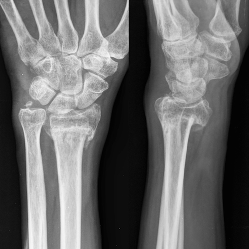 Wrist radiograph (an approach) | Radiology blog post | Radiopaedia.org