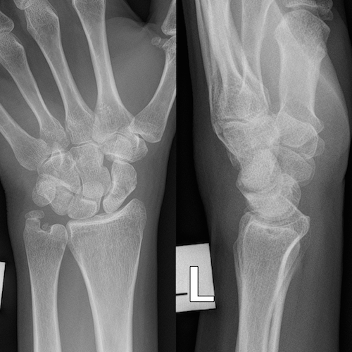 Wrist radiograph (an approach) | Radiology blog post | Radiopaedia.org