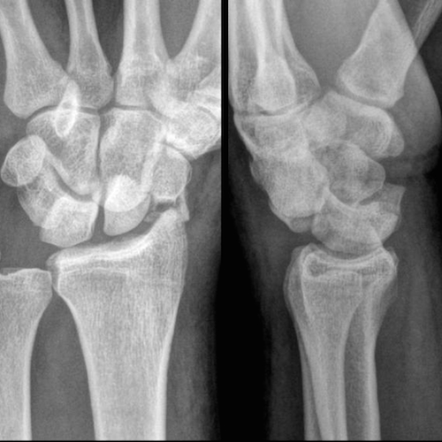 Wrist radiograph (an approach) | Radiology blog post | Radiopaedia.org