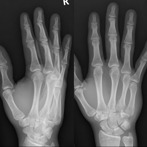 Wrist radiograph (an approach) | Radiology blog post | Radiopaedia.org