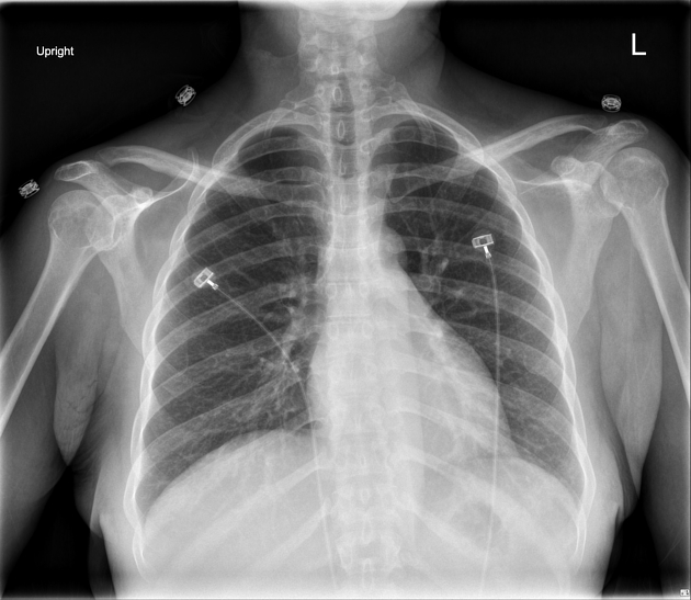 Multiple View Of The Rib Cage #1 Photograph by Science Picture Co