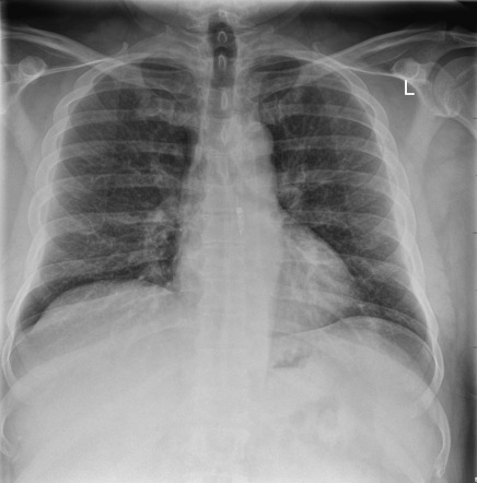 Medical devices in the thorax | Radiology Reference Article ...