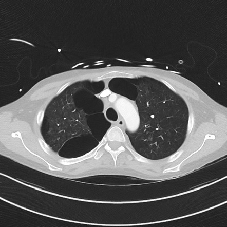 Apical bullous disease in a heavy smoker | Radiology Case | Radiopaedia.org