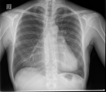 Depressed sternum | Image | Radiopaedia.org