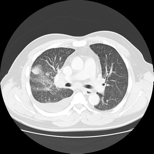 Miliary tuberculosis | Image | Radiopaedia.org