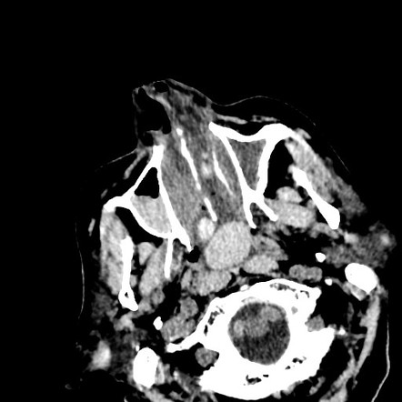 Nasal fungal balls | Radiology Case | Radiopaedia.org