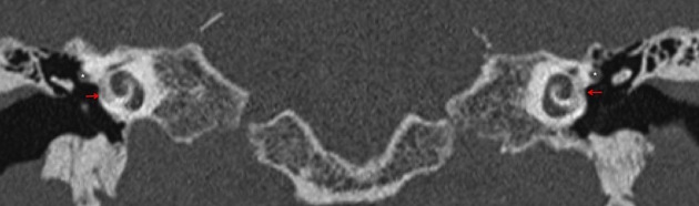 Fenestral Otosclerosis Radiology Case Radiopaedia Org