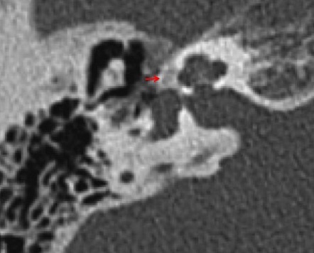 Otosclerosis | Radiology Reference Article | Radiopaedia.org