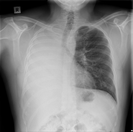 Complete bronchial obstruction | Image | Radiopaedia.org