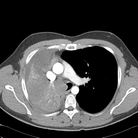 Complete bronchial obstruction | Image | Radiopaedia.org