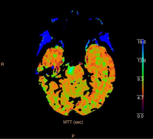 CT perfusion in ischemic stroke | Radiology Reference Article ...