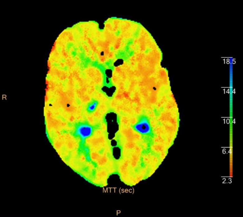 CT perfusion - lacunar infarct | Image | Radiopaedia.org