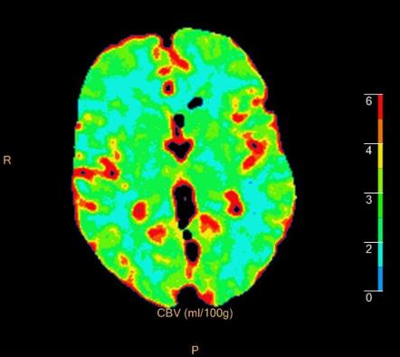 CT perfusion - lacunar infarct | Image | Radiopaedia.org