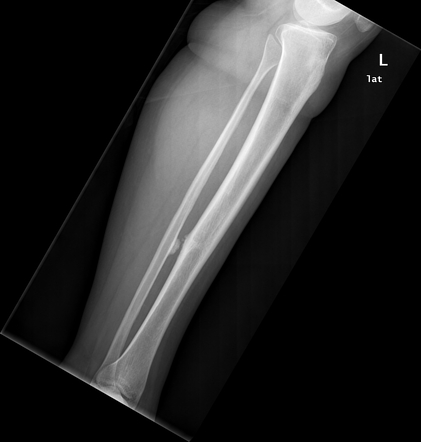 Middle tibiofibular synostosis | Image | Radiopaedia.org