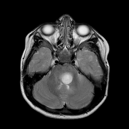 Brainstem glioma | Image | Radiopaedia.org