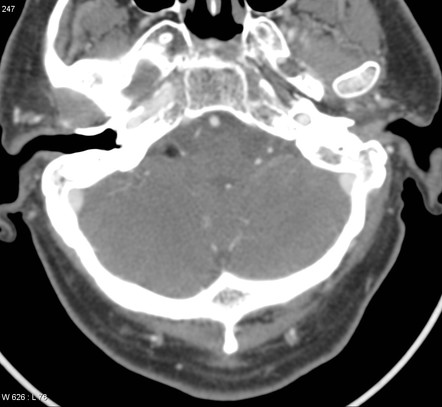 Intracranial lipoma | Radiology Reference Article | Radiopaedia.org