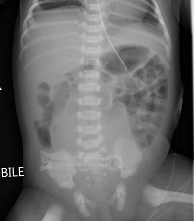 Bladder distension on abdominal radiograph | Radiology Case ...