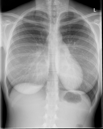 Pectus Excavatum 