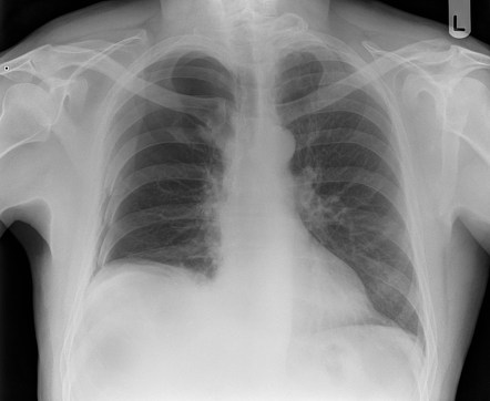 Pneumothorax | Radiology Case | Radiopaedia.org