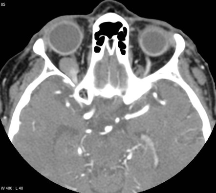 Rhabdomyosarcoma (orbit) | Radiology Reference Article | Radiopaedia.org