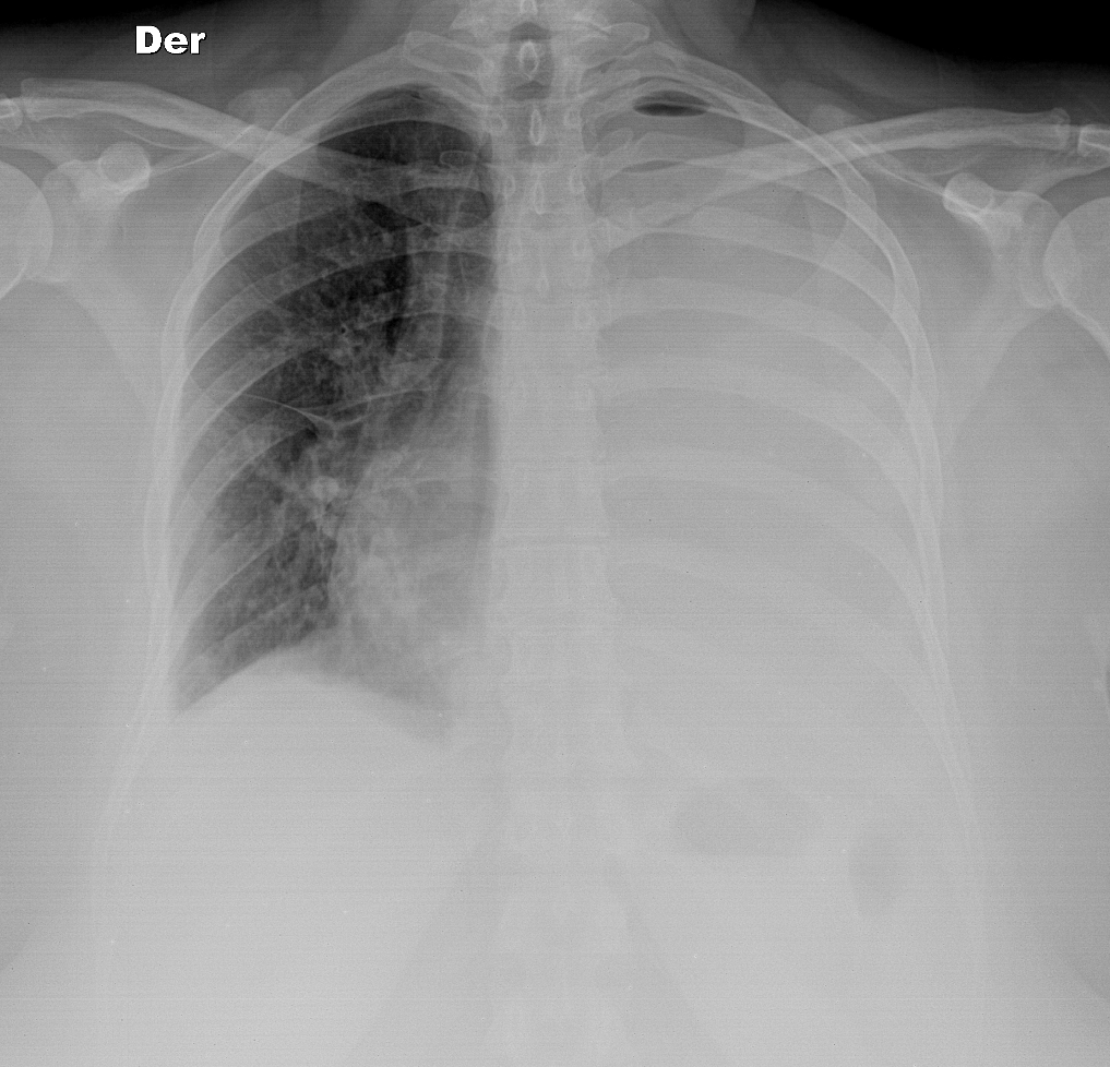 Pleural empyema | Image | Radiopaedia.org