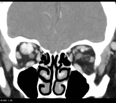 Orbital cavernous venous malformation | Radiology Reference Article ...